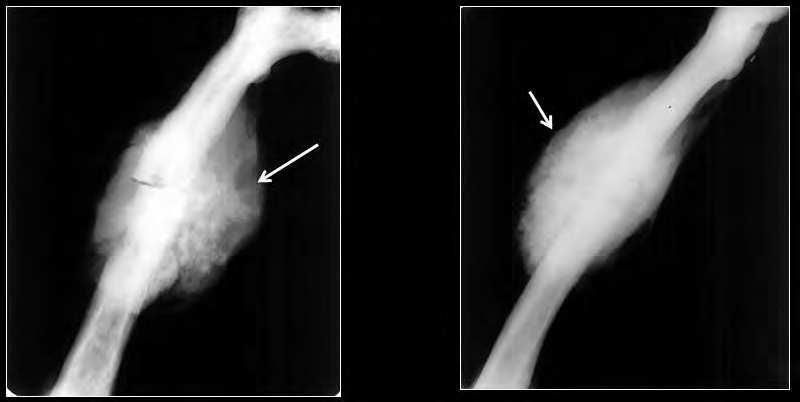 Imaging Osteosarcoma 49 Diaphyseal OS located in the diaphysis are radiologically similar to classical OS. Rarely, diaphyseal OS may have a more sclerotic appearance resembling a benign process.
