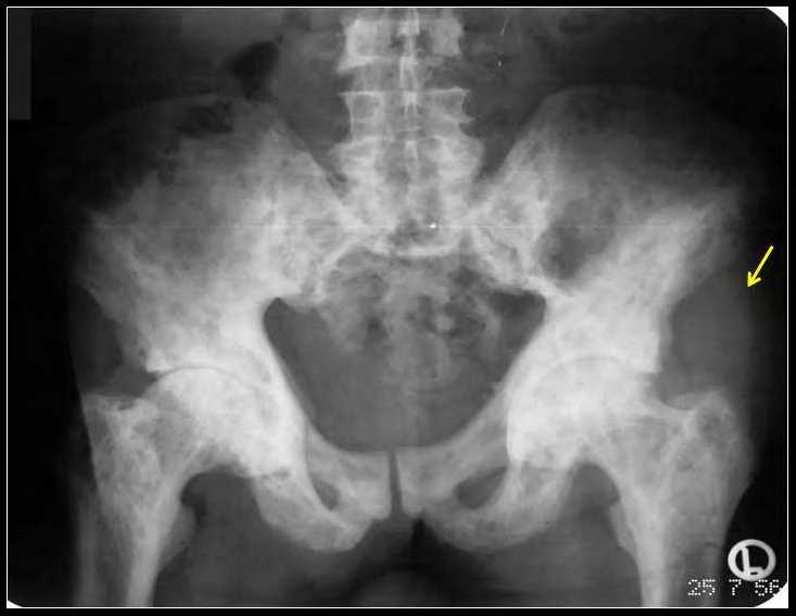 50 Osteosarcoma Fig. 9. Radiograph of a pelvis shows considerable sclerosis and coarsening of the trabecular pattern suggestive of Paget s disease.