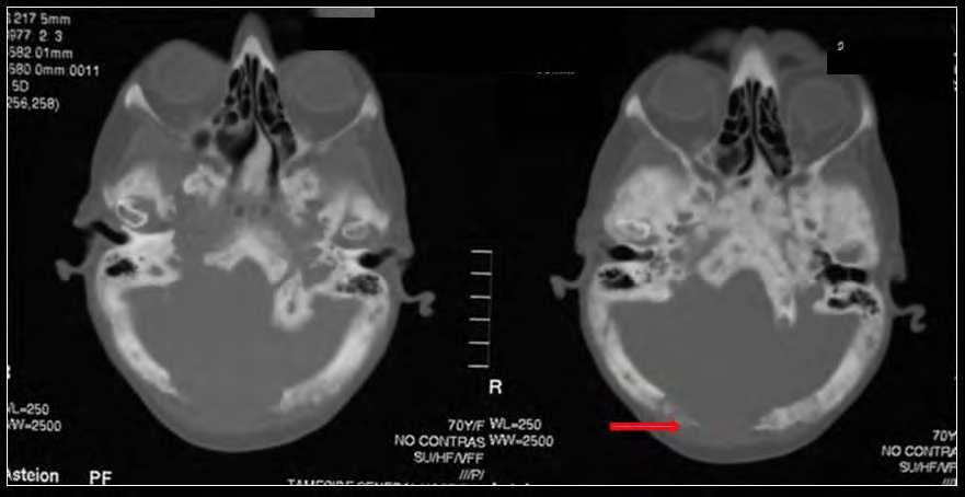 Imaging Osteosarcoma 51 Fig. 10. Non-contrast CT scans performed on the skull of a 70-year old female known to have Paget s disease.