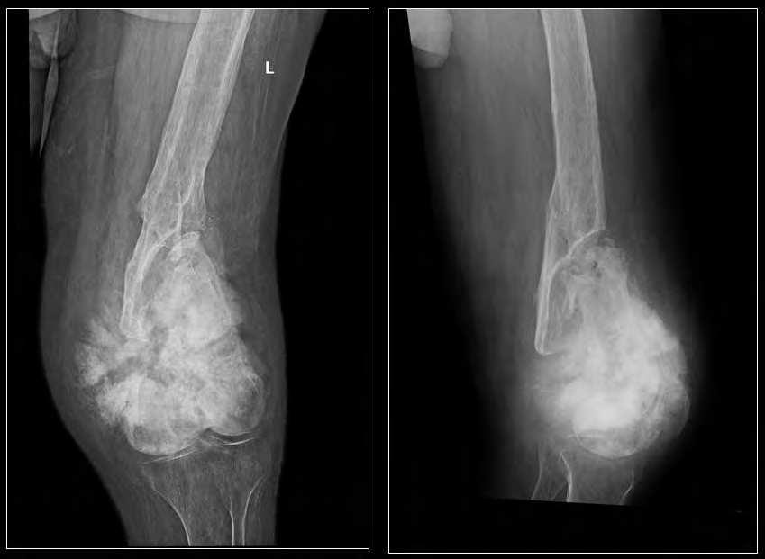 Imaging Osteosarcoma 53 Fig. 13. AP and lateral radiographs of the lower femur of 76 year old man that had suffered from chronic osteomyelitis for some years.
