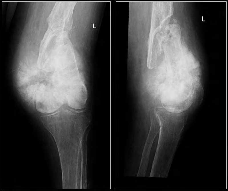 54 Osteosarcoma Fig. 14. AP and lateral radiographs of the lower femur of 76 year old man that had suffered from chronic osteomyelitis for some years.