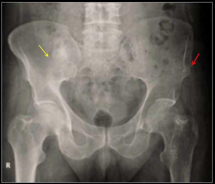 Imaging Osteosarcoma 55 Fig. 15. An AP radiograph of pelvis from a patient with known multiple hereditary exostoses that presented with a 3 month history of increasing right buttock pain.