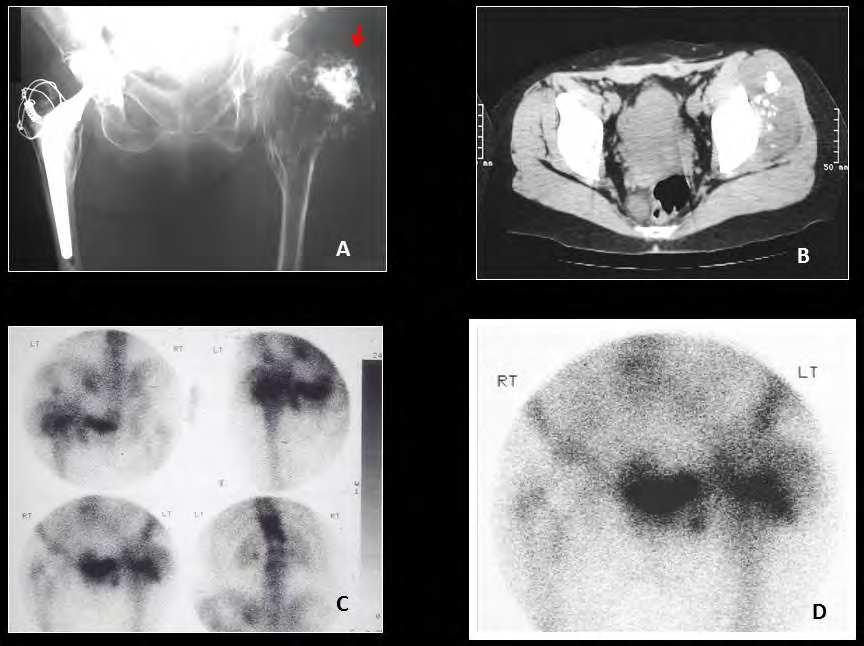 56 Osteosarcoma Fig. 16. Series of images from a patient with a long and family history of multiple hereditary exostoses are shown above.