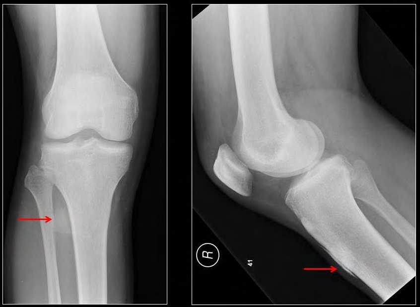 Imaging Osteosarcoma 57 Fig. 17. Imaging studies may be sometimes confusing.