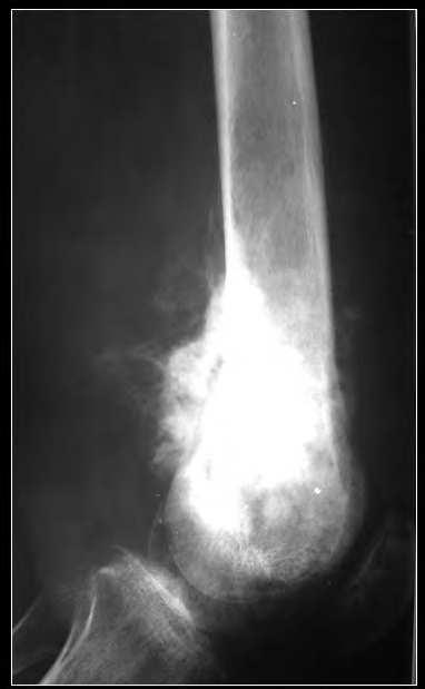 58 Osteosarcoma Fig. 18. A radiograph of the left knee of a 65-year old man is shown.