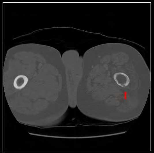 Imaging Osteosarcoma 61 Fig. 21.