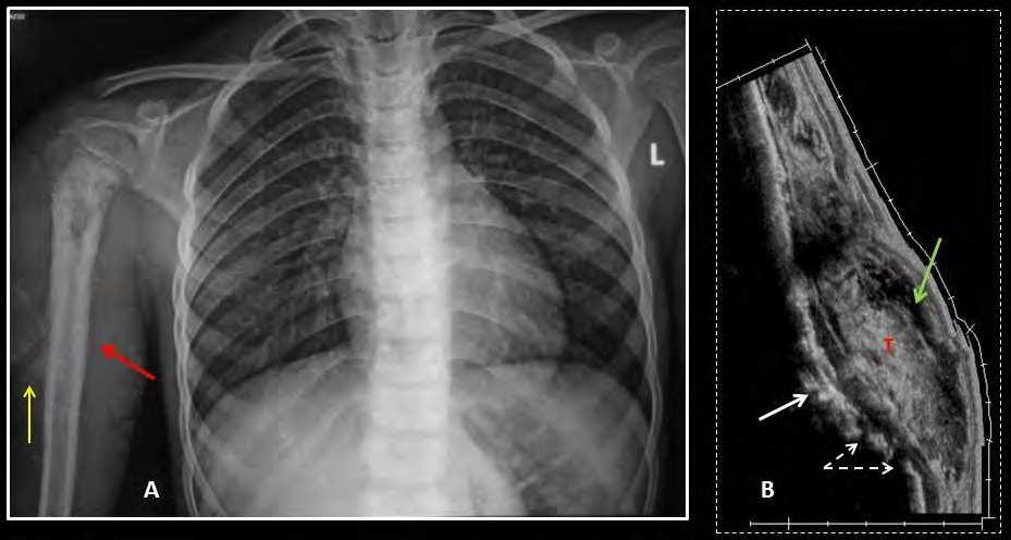 Imaging Osteosarcoma 65 Fig. 28. A chest radiograph of a 13 year old boy showing a destructive lesion of the metaphysis and upper third of the shaft of the right humerus.