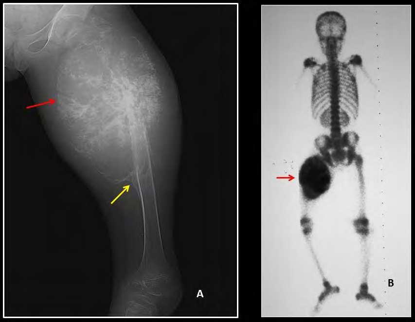Imaging Osteosarcoma 67 Fig. 30. This 12-year old boy presented with a painful swelling of the left upper thigh. A radiograph of the left, upper femur shows an aggressive bone lesion.