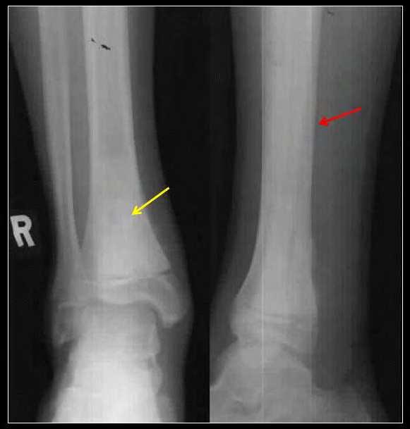 42 Osteosarcoma Fig. 1. The illustration shows a radiograph of a right ankle in a 12-year old. He presented with vague ankle pain and a slight limp.