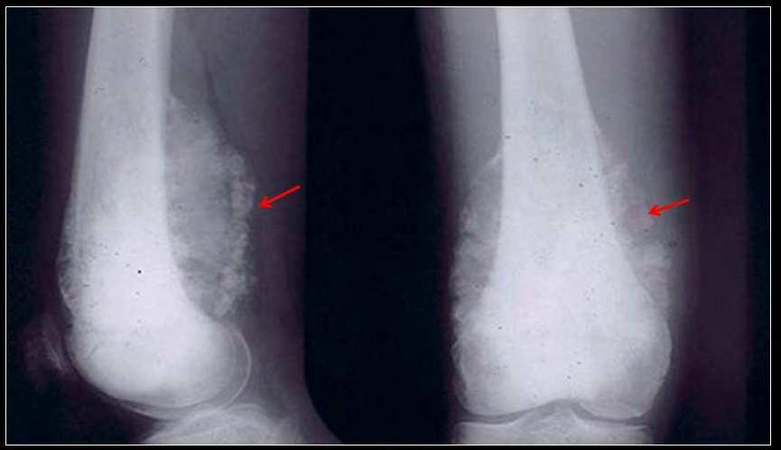 Imaging Osteosarcoma 43 Fig. 2. Radiograph of the lower femur shows a sclerotic lesion of the lower femoral metaphysis.