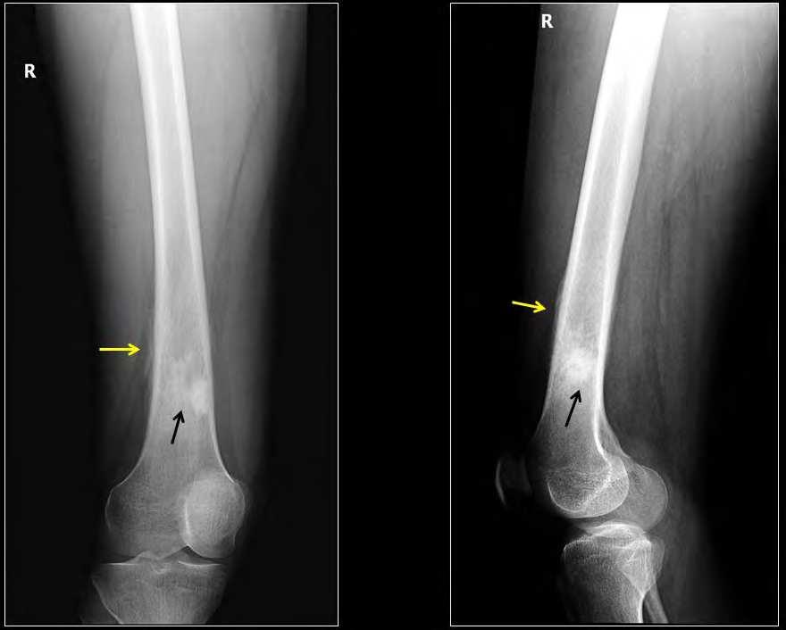 Imaging Osteosarcoma 45 Fig. 6. AP and lateral radiographs of the lower femur shows a biopsy proved diaphyseal variant of OS.