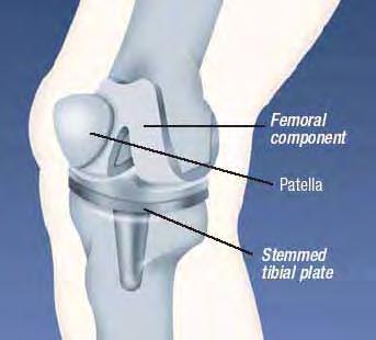 Total Knee Joint Replacement End surface of femur replaced with metal End surface of tibia replaced with