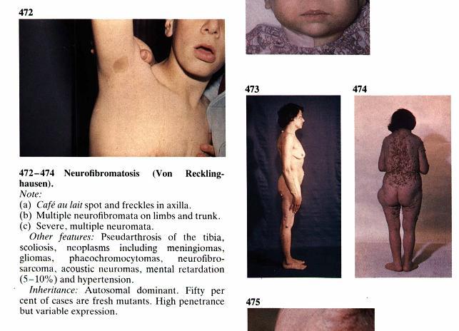 Neurofibromatosis type I (NF1) (Von-Recklinghausen disease) Growth of neurofibromas in skin Café-au-lait