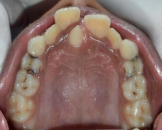 resorption, and displacement of central incisors and may extend into the nasal cavity. Hence, early diagnosis and extraction of mesiodens is very essential to avoid these types of complications.