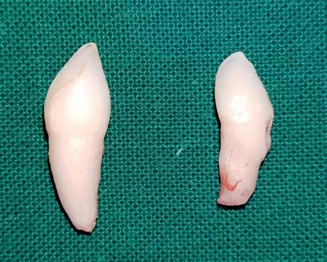 incisor. After obtaining intra- oral radiograph of maxillary right and left central incisors, we observed that the impacted and inverted mesiodens was in relation to maxillary right Central Incisor.