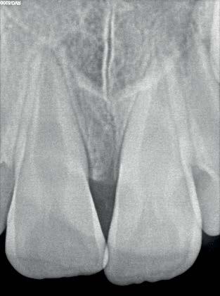 Splinting was carried out in order to stabilize right Central Incisor as tooth showed grade I mobility.