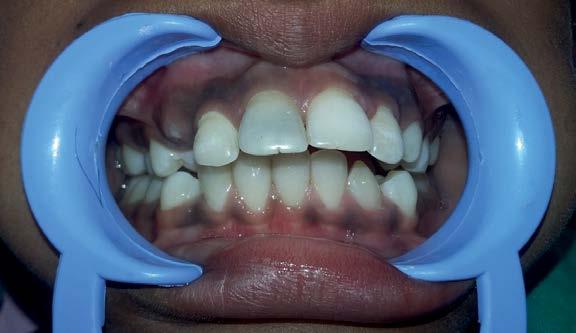 Discussion Supernumerary tooth is an extra tooth present in any area of the oral cavity which can be found both in deciduous or permanent
