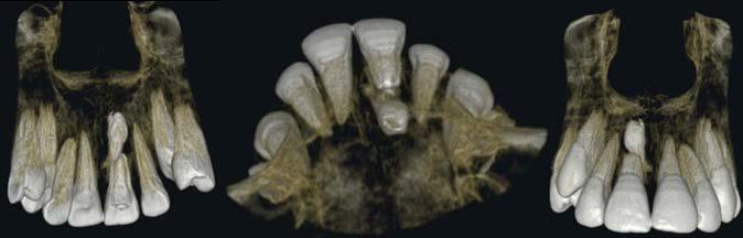 There was an impacted mesiodens approaching the root of right central incisor.