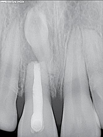 Figure 11 Figure 13 Figure 14 Completed endodontic treatment of central incisor. Figure 12 Extracted mesiodens. Radiographic follow up after 1 month. Clinical follow up after a month.