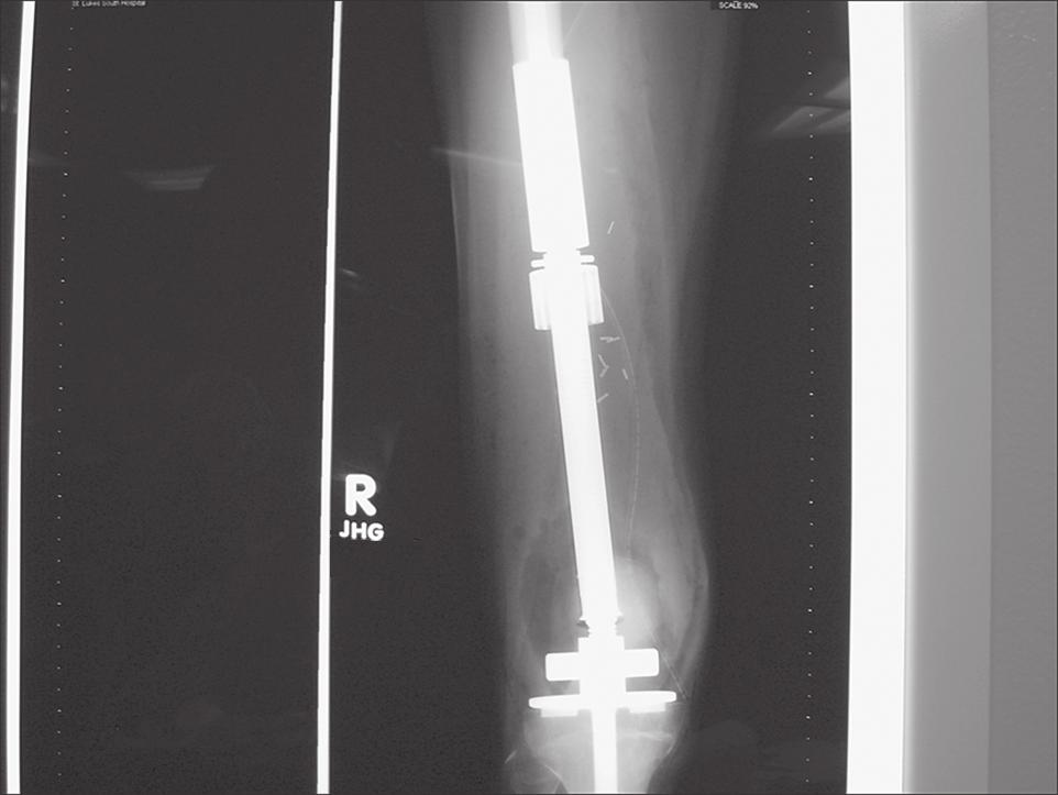 F IGURE 1. Anteroposterior plain film of a Repiphysis prosthesis implanted in the distal femur (courtesy of Dr. H. Rosenthal). as they continue to grow and reach skeletal maturity.