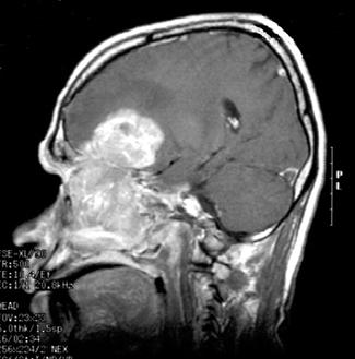 of ethmoid sinus Age: Bimodal age presentation (young or old) Sex: Equal gender Symptoms: Non-specific; Anosmia <5% Imaging: A