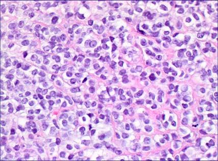 Poorly differentiated squamous cell carcinoma 6. Lymphoma 7. Olfactory neuroblastoma 8.