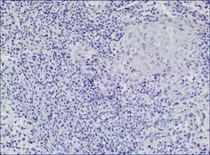 Poorly differentiated squamous cell carcinoma, pending IHC 3.