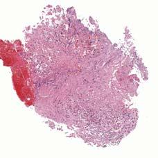 unencapsulated tumor Invades into subepithelial stroma and