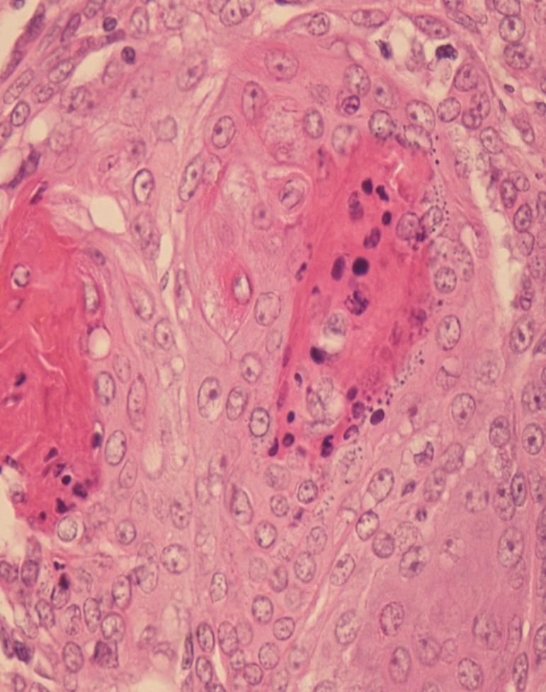 inclusion cyst Squamous