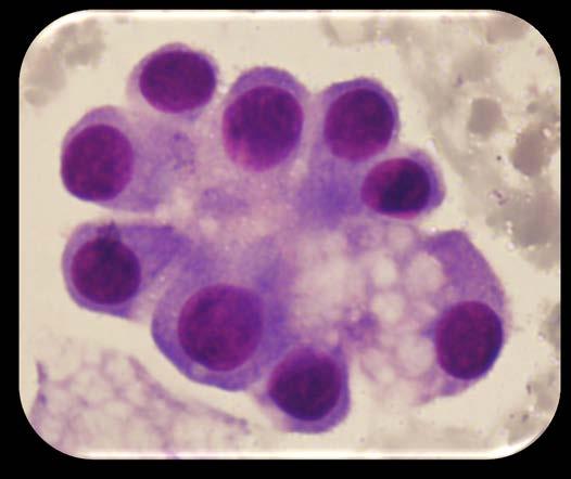 Glandular cell tumor