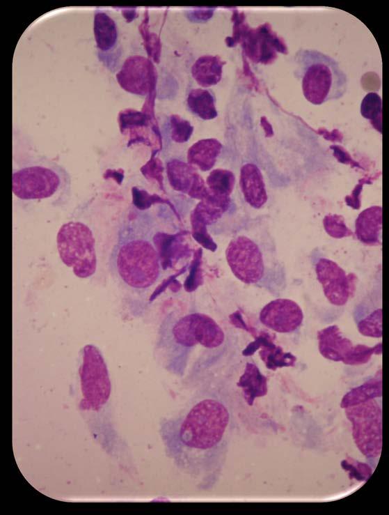 Spindle Cell Tumor