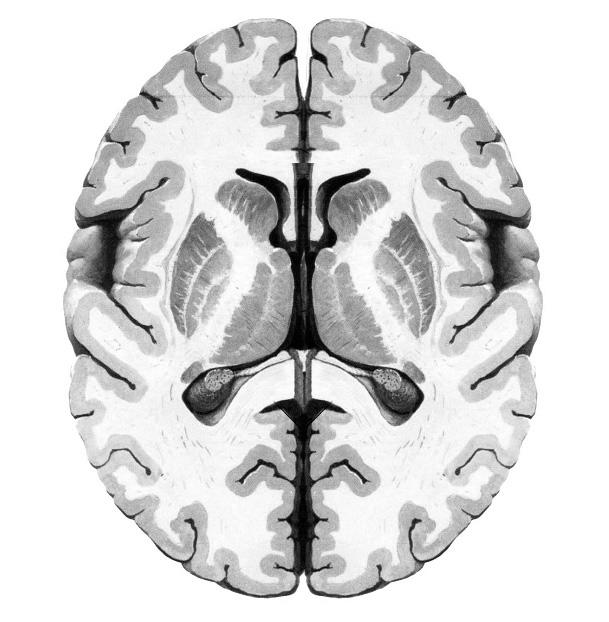Diagnostic Tests CAUDATE Clinical diagnosis for typical case Neurological consultation MRI?