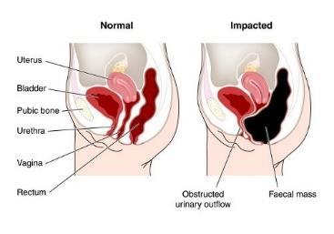 Symptoms of Control Problems Chronic constipation (4+ million people in U.S.) Bowel movement fewer than 3