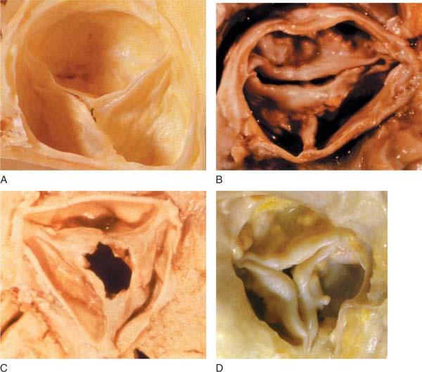 Aortic Valve Gross Patho-Anatomy Normal