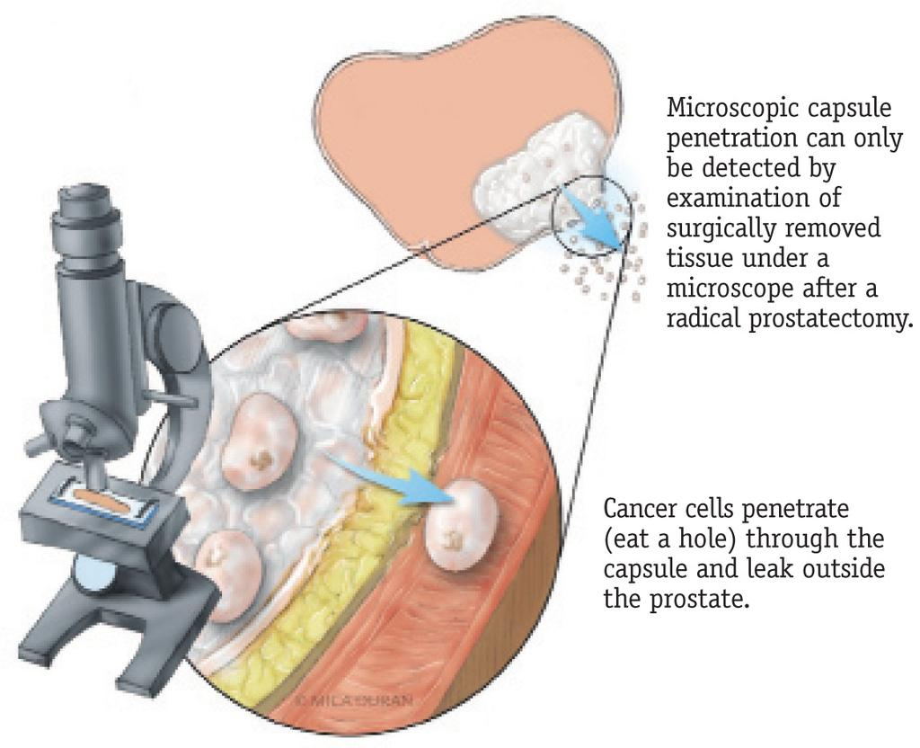 Because the cancerous cells are often located near the wall of the prostate, cells can destroy the capsule, leak out and spread to other nearby areas, such as the rectum or bladder.