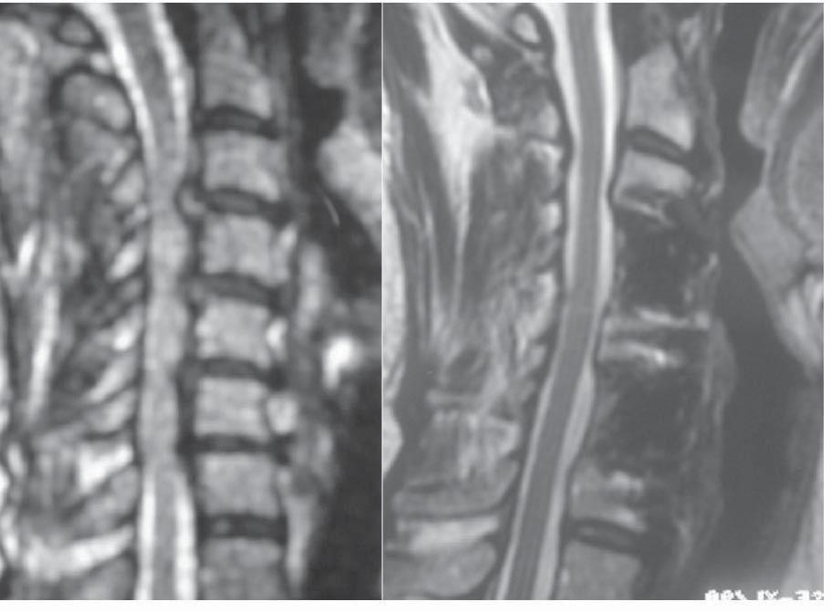 52 E. SHKENZI also paid to any evidence of instrumentation failure. Pre and post-operative Nurick myelopathy scores were obtained in all patients.