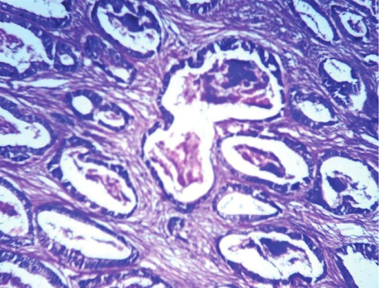 On histopathological examination, 37 cases (86%) were adenocarcinomas (including intestinal and diffuse type of adenocarcinoma of the Lauren s classification), in which 25 were moderately
