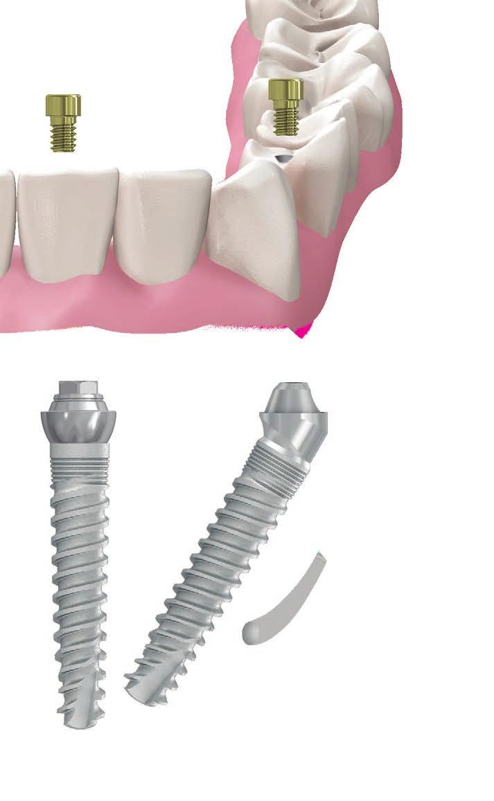 Multi-Unit abutments and final fixed screwretained restoration is immediately placed over the implants.