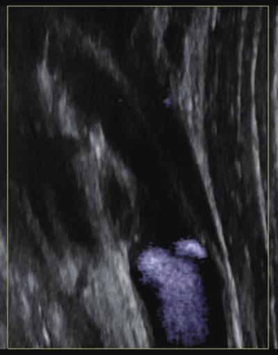 (arrow) of the left ICA; B, Preoperative color-ﬂow duplex ultrasound showed a poorly echogenic thrombus with a ﬂow void, suggestive of a