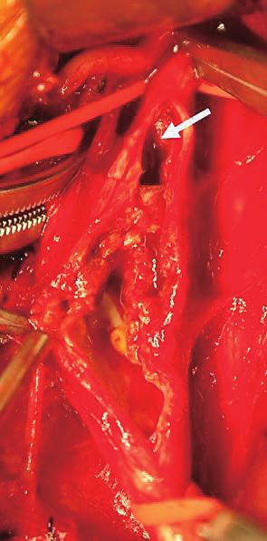 Note the surgical specimen after carotid endarterectomy (CEA) with Fogarty thrombectomy; E, After staged bilateral CEAs were performed,