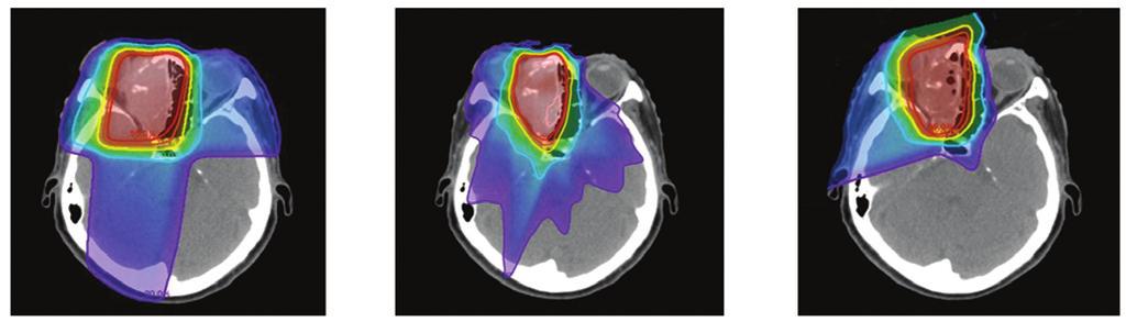 Representative dose distribution of proton therapy for ethomoid sinus squamous cell carcinoma (target, magenta. Isodose lines: 95%, red; 90%, orange; 80%, yellow; 60%, green; 50%, blue; 20%, purple).