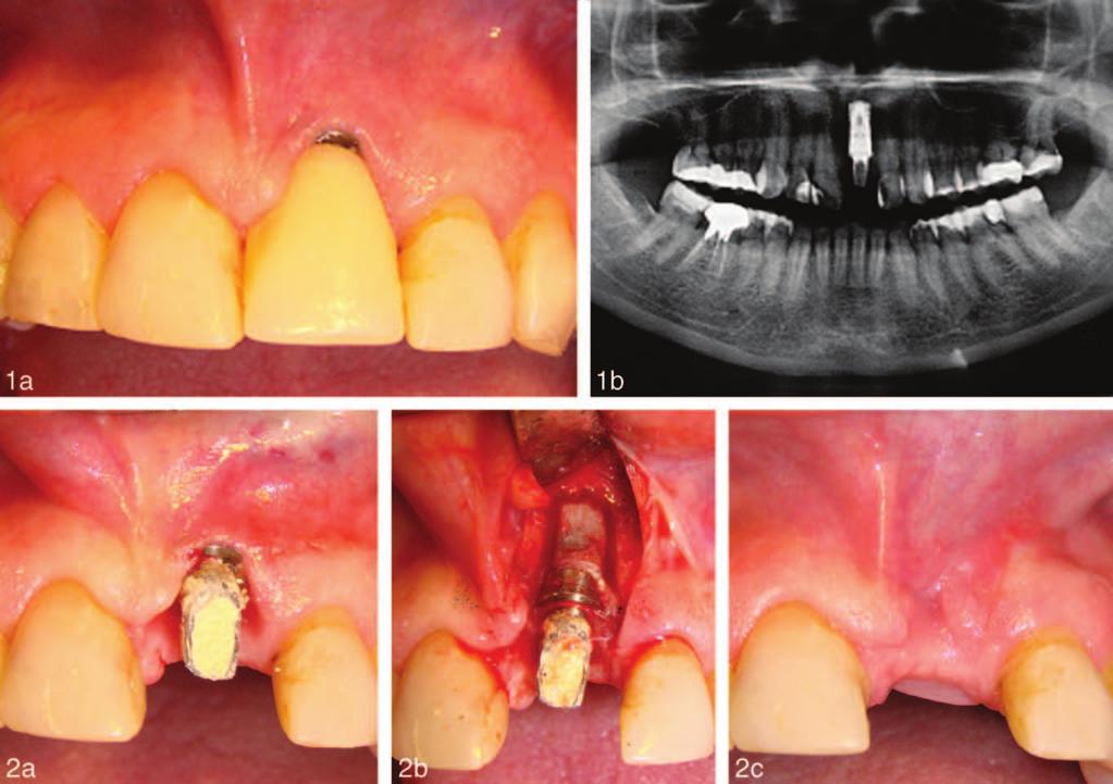Correction of Esthetic Complications of a Malpositioned Implant FIGURES 1 AND 2. FIGURE 1. Initial (a) clinical and (b) radiographic aspects. FIGURE 2.