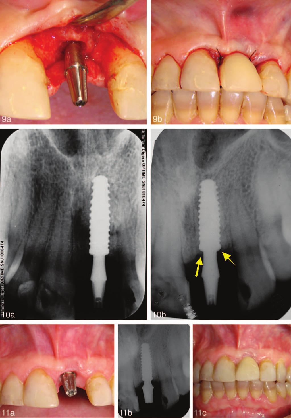 Correction of Esthetic Complications of a Malpositioned Implant FIGURES 9 11. FIGURE 9. The (a) abutment positioned and (b) temporary tooth. FIGURE 10.