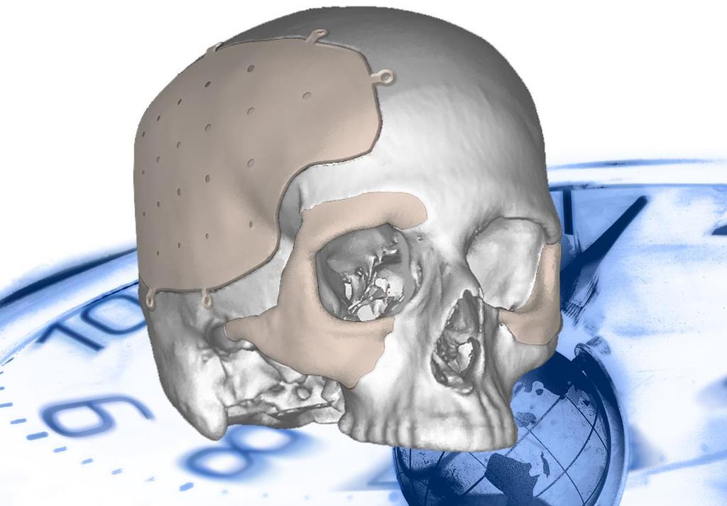 Customized Cranial