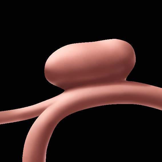 Wide-necked aneurysms are particularly difficult to
