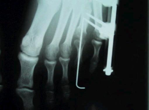 as medial and plantar angulation of the metatarsals during distraction. On the right foot, the fourth MTP joint was exposed for accurate placement of the K-wire across the joint.