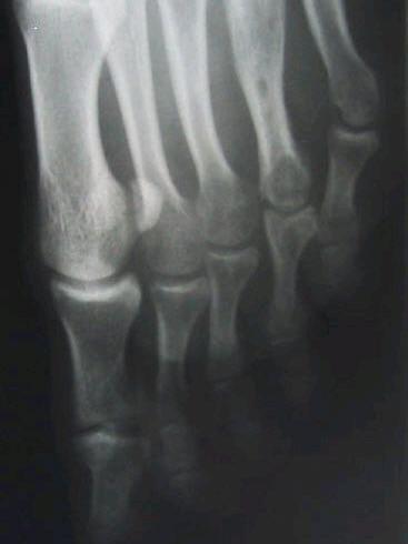 Distraction of the left fourth metatarsal was discontinued after twenty days due to medial and plantar angulation of the metatarsal. The desired length was also not achieved.