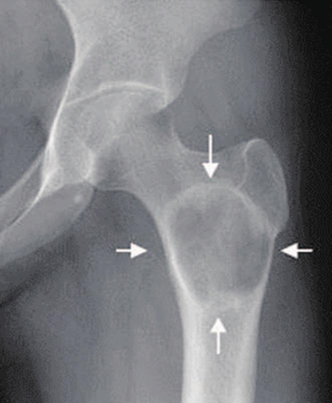 Won Chul Shin et al. Primary Intraosseus Xanthoma Involving the Proximal Femur in a Normolipidemic Patient The pain was worse during activity.