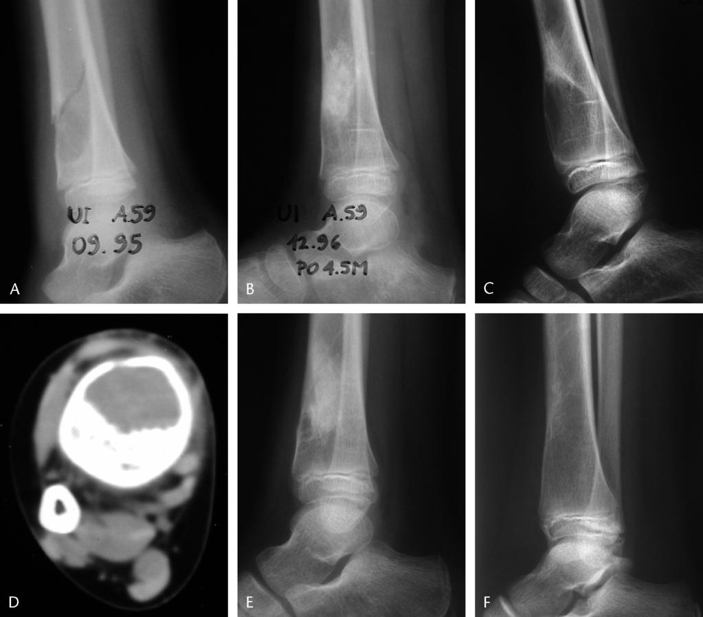 J Pediatr Orthop & Volume 27, Number 8, December 2007 lesion which may affect recurrence rates for primary ABCs in children.