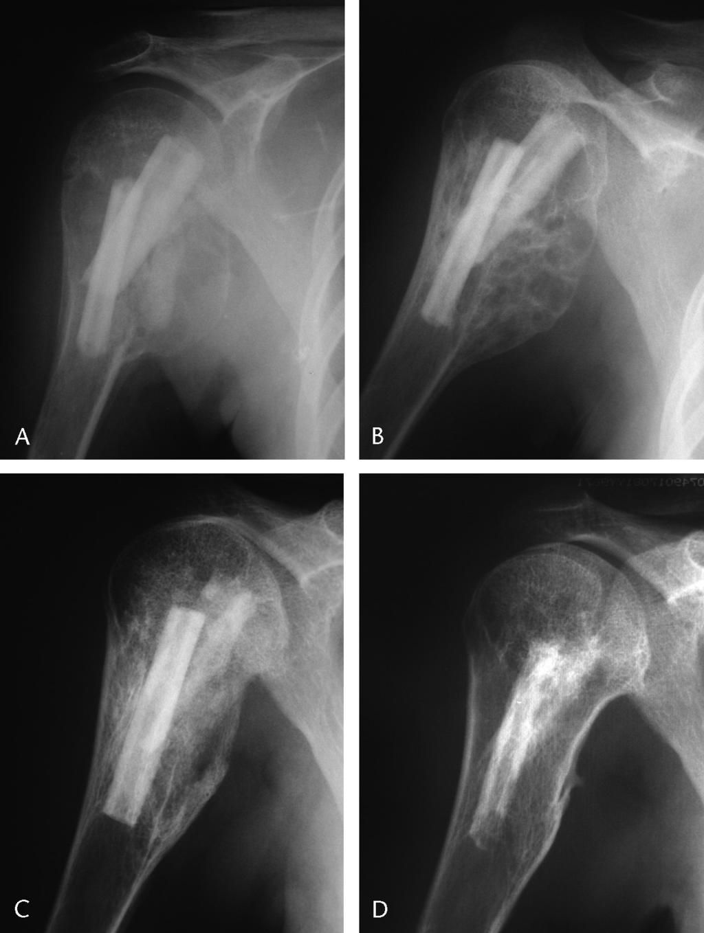 BazarNr etal J Pediatr Orthop & Volume 27, Number 8, December 2007 grafts, and occasionally with bone cement.